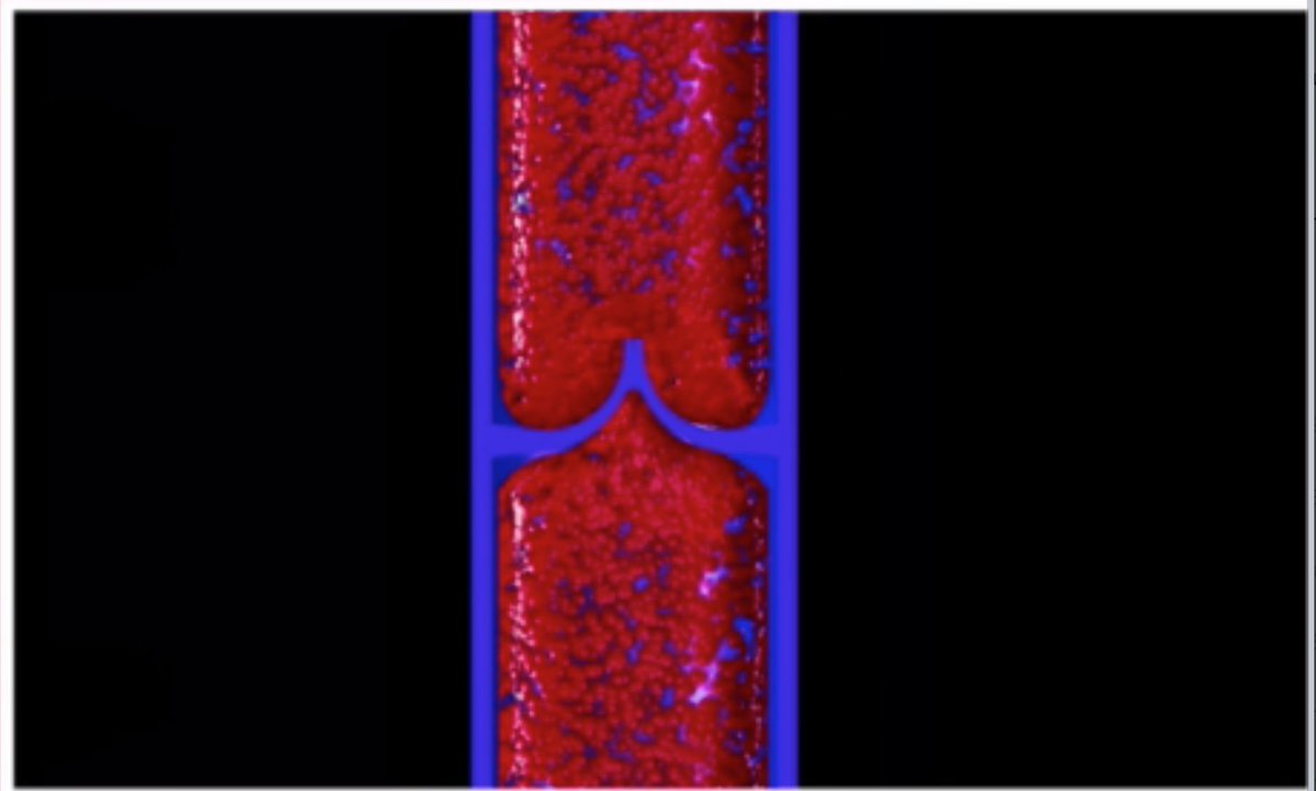 ElisirTv's tweet photo. La #flebite è un'infiammazione della parete venosa, che avviene perché il sangue si coagula all’interno della vena. Si parla quindi di tromboflebite perché il trombo, altro non è che un coagulo. https://t.co/p9PdhWwNbl