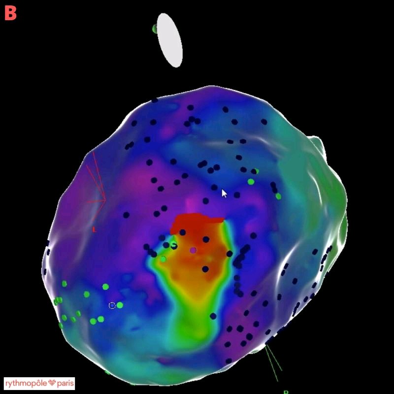 rythmopoleparis's tweet photo. One of our best VT #ablation was performed by a #cardiac surgeon!!! 
68yo lady with DCM presented with cardiogenic shock and incessant slow VT (135 bpm Panel A). CRT-D previously implanted with surgically implanted #LVlead. https://t.co/o7jhUsJNMO