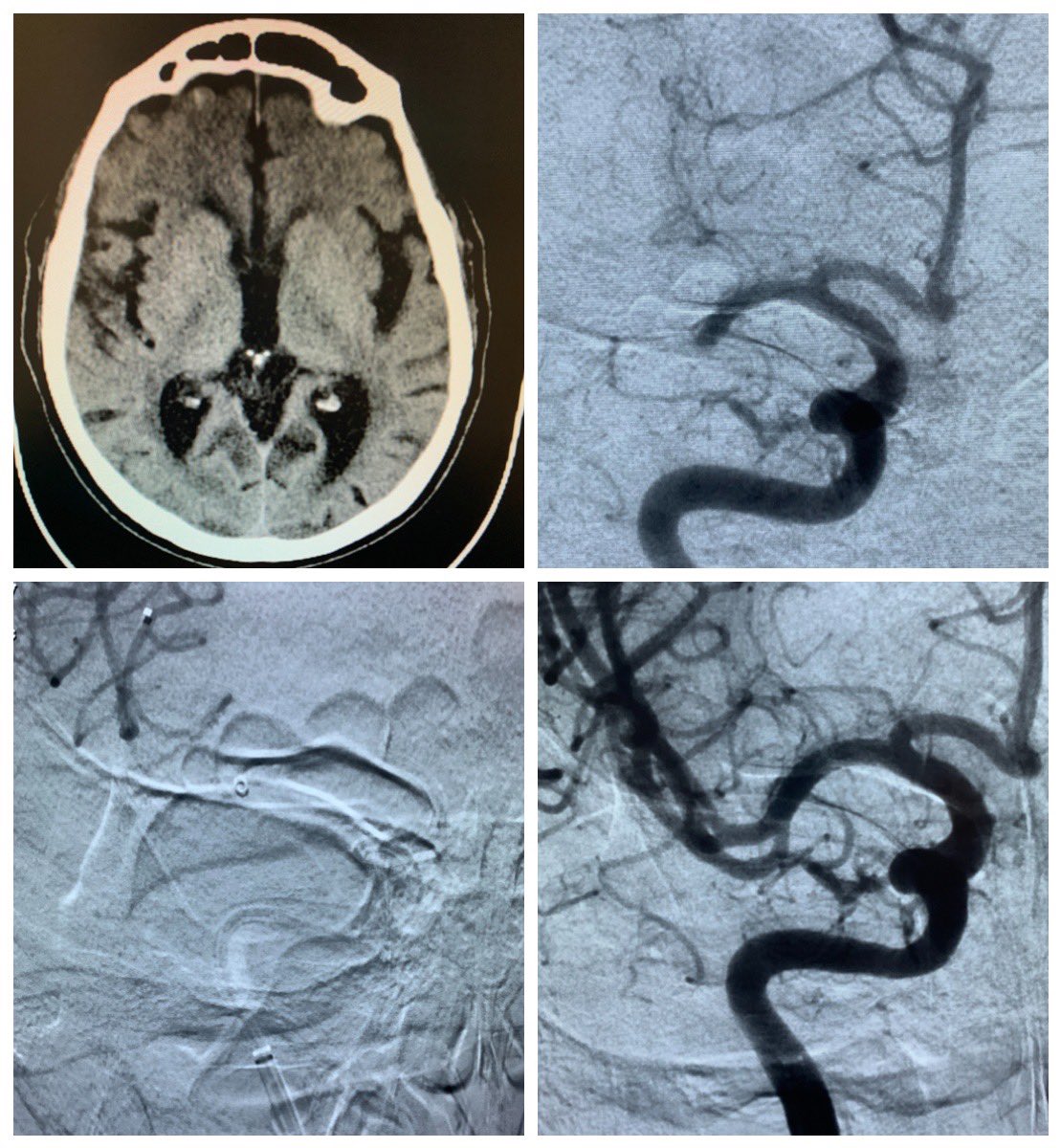 2 hours onset. Right M1 occlusion. NIHSS 2. ASPECTS 10. Recanalization using “Solumbra” technique (First pass TICI 3)