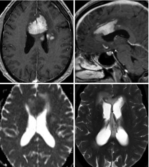 The answer to yesterday’s #imagechallenge was….Primary CNS Lymphoma (PCNSL)!  PCNSL is an extranodal malignant lymphoma arising in the CNS without concurrent systemic lymphoma and is primarily a non-Hodgkin/diffuse large B-cell lymphoma. 

neurosurgicalatlas.com/volumes/neuror….