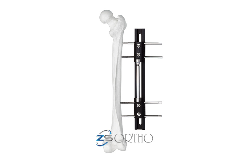 ZSORTHOSOLUTION's tweet photo. External fixation
https://t.co/0vAv78fehO
#externalfixator #orthopaedicsurgeons #orthopedicsurgery #medicaldevices #fracture #externalfixator #saturnortho #bonefixator #bonefixation #ortho #orthopaedic #orthopedic https://t.co/ITH6DP7EU8
