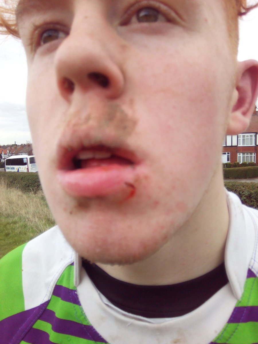 hncrl15's tweet photo. The boys didn't get the win but certainly fought back and put in a solid 2nd half performance. We lost our captain (cut lip inside & out) early 2nd half but the boys put up a great fight just going down 34 - 24 away to Ponte. #plentytoworkon #development #allmatestogether https://t.co/s1QKHrgeCM