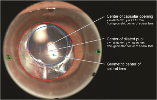 ophthopedia's tweet photo. Ophthopedia Update: Alignment of a wavefront-guided scleral lens correction in the presence of a lens capsulotomy https://t.co/EErMngIWaA #eye #Ophthalmology #CLAE https://t.co/jgdFhECyN1