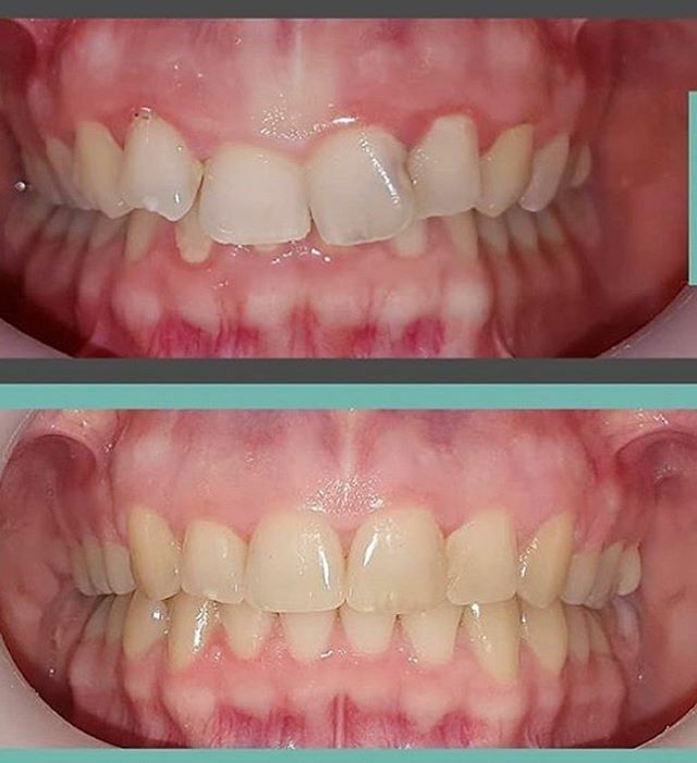 GeoNuvola's tweet photo. Nuvola the aligner that simplify your work! 😉The cutting-edge materials and the highest precision simulation methods used, guarantee the success of the treatments 🙌#dentists#dentistry#orthodontist #nowires#smilemore#aligners#straighteeth#bettersmile#… https://t.co/sPeFhjwFhI https://t.co/DwtqaYBY1F