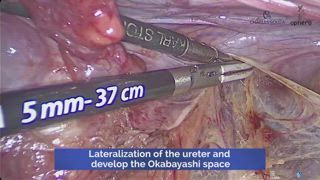 AAGL's tweet photo. Radical #trachelectomy can be associated with significant morbidity if the nerves are not spared. Watch this #SurgeryU #SurgeryNew video to see how developing the pararectal spaces and isolating the hypogastric #nerves can facilitate a safe dissection.
https://t.co/07h1SYdzVC https://t.co/5hWidyiRAX