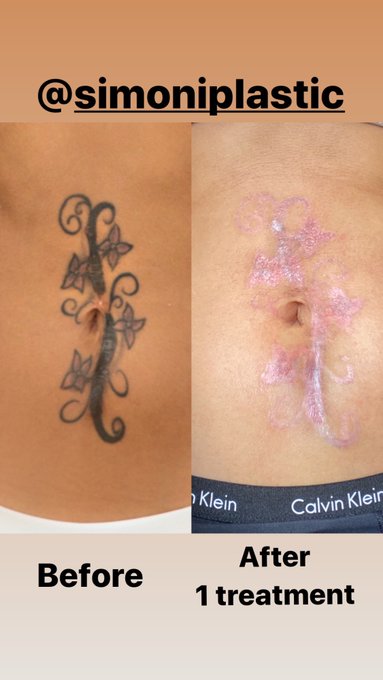 My Tattoo is almost gone!!!!! https://t.co/Vi1YAx6Ize<a href="/tag/bride"class="tags"><span>#bride</span></a><a href="/tag/wedding"class="tags"><span>#wedding</span></a><a href="/tag/weddingdress"class="tags"><span>#weddingdress</span></a><a href="/tag/bridesmaids"class="tags"><span>#bridesmaids</span></a><a href="/tag/groom"class="tags"><span>#groom</span></a>