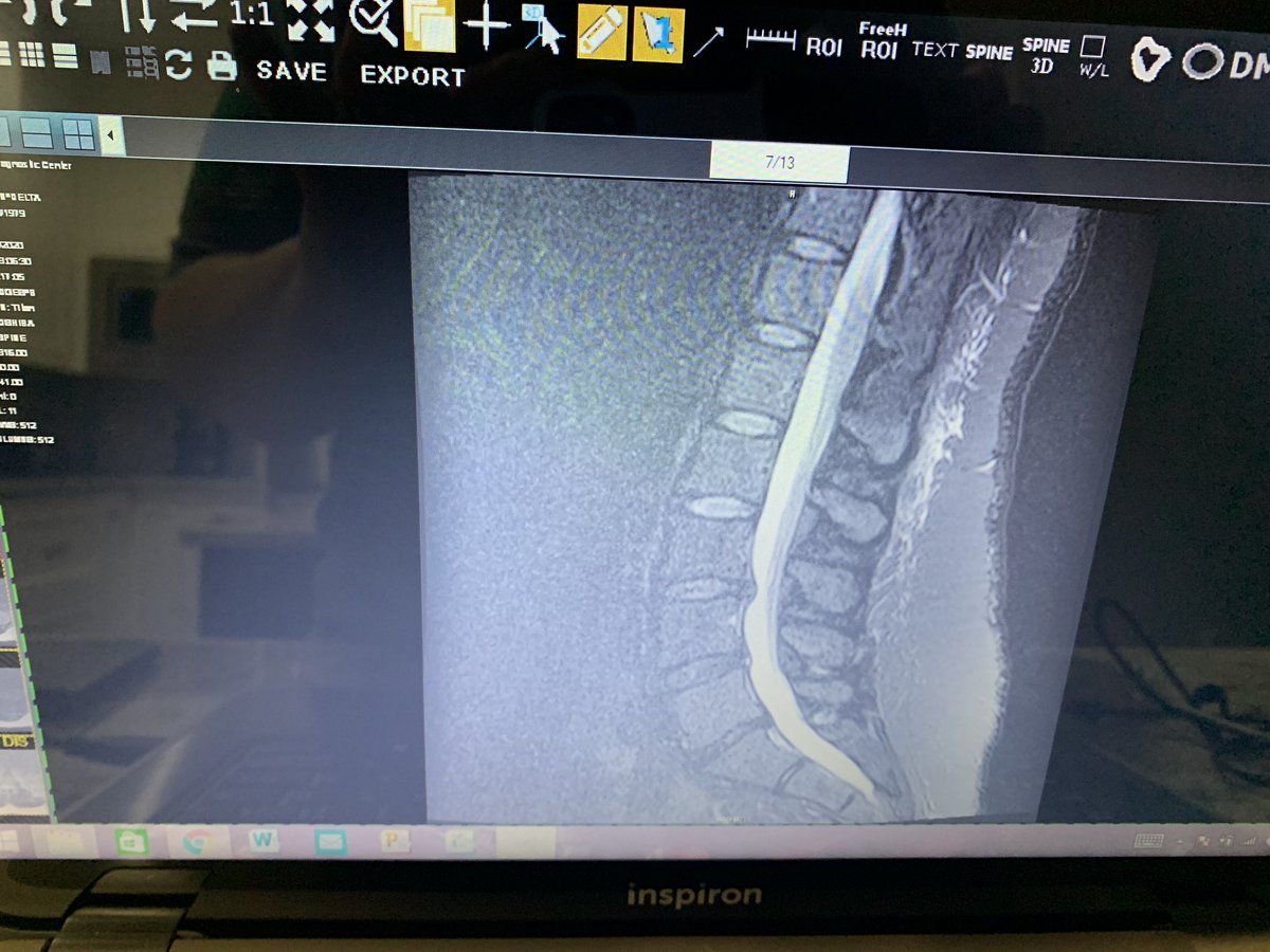 DeltaGunn's tweet photo. M51.16
M51.17
M53.3
M46.1
M31.8
Fun stuff right here. 
#myspinesucks
#DDDWithDisplacement #AndRadiculopathy
#AndFasciculations
#SIJointDysfunction
#ChronicSacroilitis
#Retrolisthesis 
#remotecoder #remoteauditor #workfromhome #goodthingtoo https://t.co/wBbZ1BdN5B