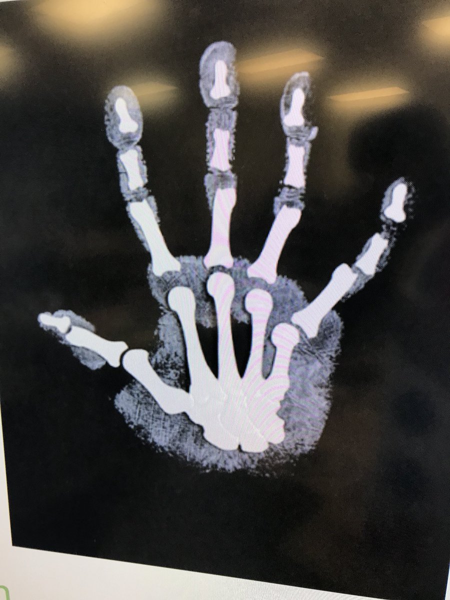 lyarboro's tweet image. Can you create a model x-ray of the hand? We can! #pltw ##learninghandson #inquirylessons