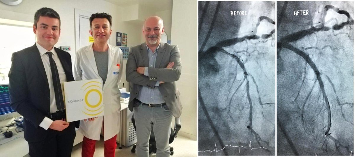 Very impressive before and after of an LCx treated with #ShockwaveIVL by Prof Timur Timurkaynak &amp; team at Istanbul Bayindir Hospital in Turkey! Excellent luminal gain and final result. ISI bit.ly/2s7zs7j #ShockwaveC2 #IVL #CardioTwitter