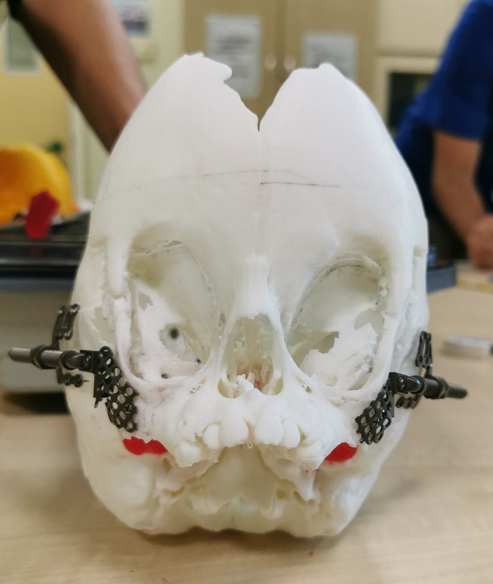 drnorfaizalab's tweet photo. Time to do the real job after #Ottawa2020 #ottawaassessment2020 How to reconstruct #craniofacial #crouzon This certainly a team effort #maxfac #paediatrics #PaedsAnaest #PaedsICU #PaedsENT #PaedsOpthal https://t.co/j7X4ZB8CaB