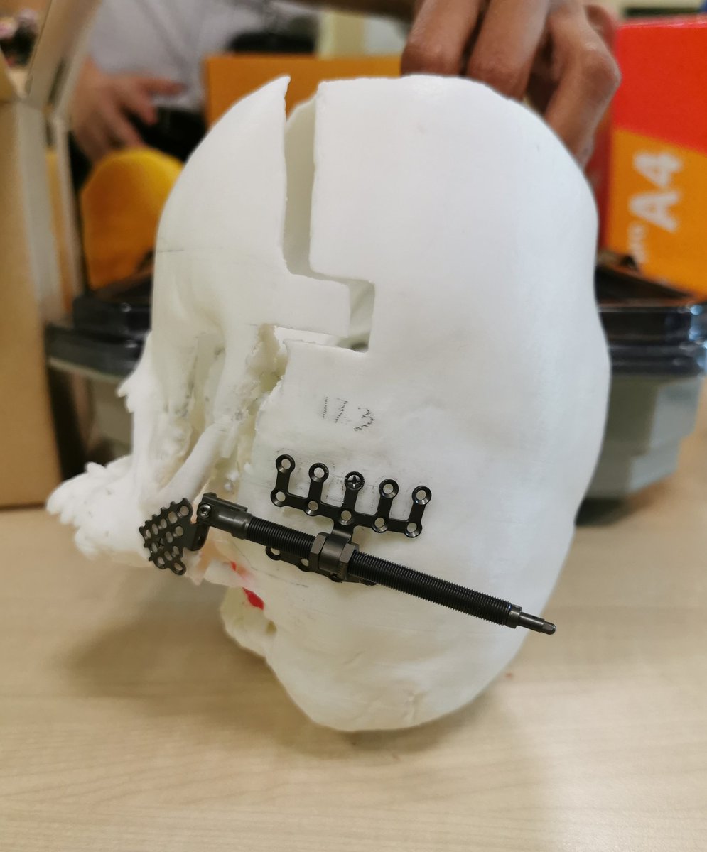 drnorfaizalab's tweet photo. Time to do the real job after #Ottawa2020 #ottawaassessment2020 How to reconstruct #craniofacial #crouzon This certainly a team effort #maxfac #paediatrics #PaedsAnaest #PaedsICU #PaedsENT #PaedsOpthal https://t.co/j7X4ZB8CaB
