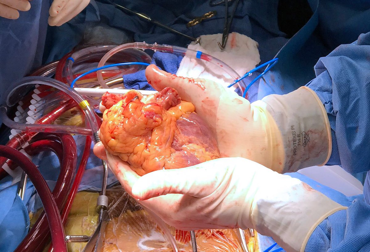 CTFletcherISYMF's tweet photo. YES ITS A “MEDICAL MIRACLE” AND THE FACT THAT I RECEIVED A HEART THAT WAS SUPPOSEDLY TO SMALL FOR MY BODY AND IS NOW GROWN TO THE PROPER SIZE FOR MY BODY AND FUNCTIONING AT 100% IS A “MIRACLE FROM GOD!” SO ITS A “DOUBLE MIRACLE” https://t.co/MlYdgC9hWU