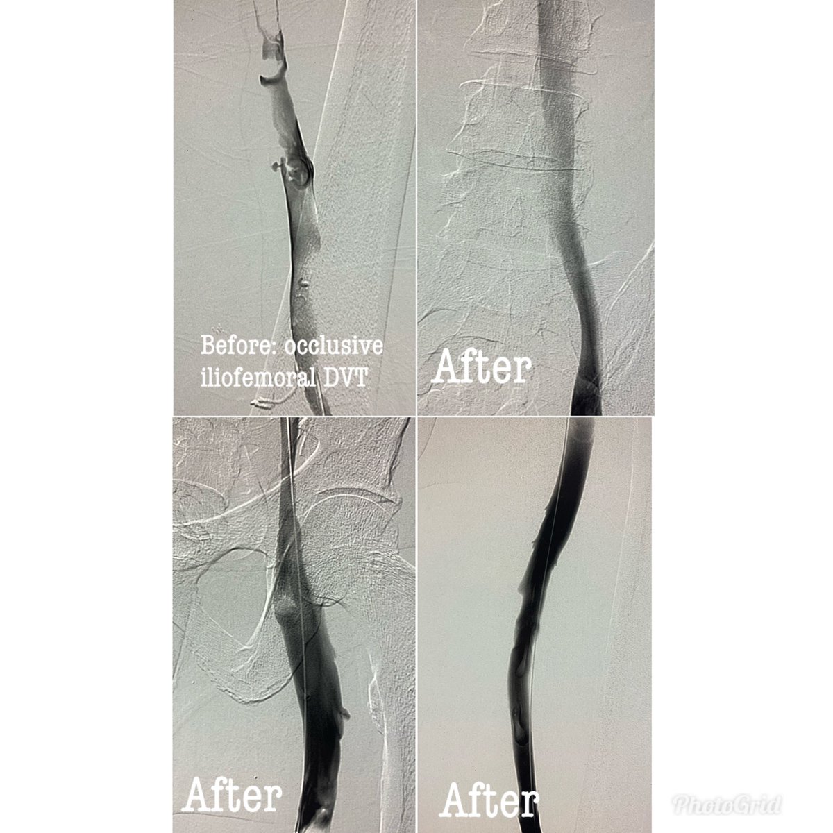 Acute iliofemoral DVT with severe pain and edema.  Inability to bear weight.  Much improved at 48 hours post thrombectomy.  Used ClotTriever -> 3 passes and 45min case with great clinical and venographic result! #iRad