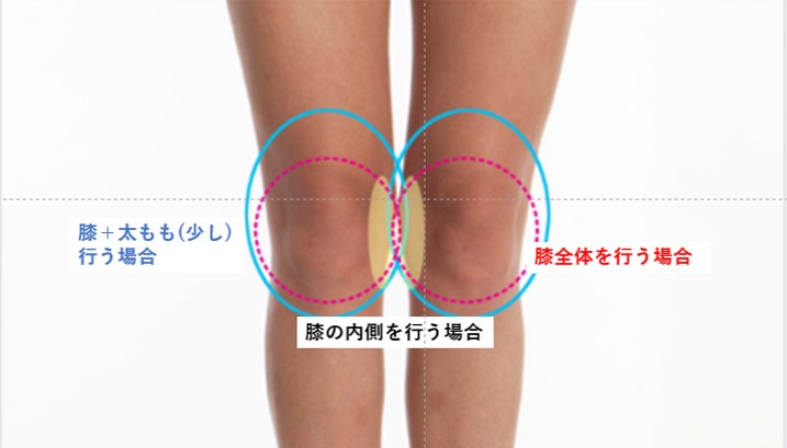 Jsme Clinic Js美クリニック Js美クリニックの膝の脂肪吸引施術に関するブログをアップしました ぜひみてください 韓国 ソウル 美容整形 脚整形 美容 韓国整形 膝 脚痩せ