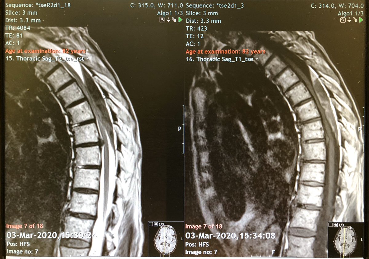 GeorgeSpinePhys's tweet photo. Might be of interest @mercephysio1 @LaurafinucaneB @sue_greenhalgh #spinalmasqueraders F 82 severe right epigastric pain admitted. Nil trop, v.mild ⬆️CRP&amp;Amylase. Day+1 total weakness gd 0 both LL, areflexic, Urine retention. Nil UMN signs. Initial Lsp MR NAD https://t.co/oqwfXzf83t