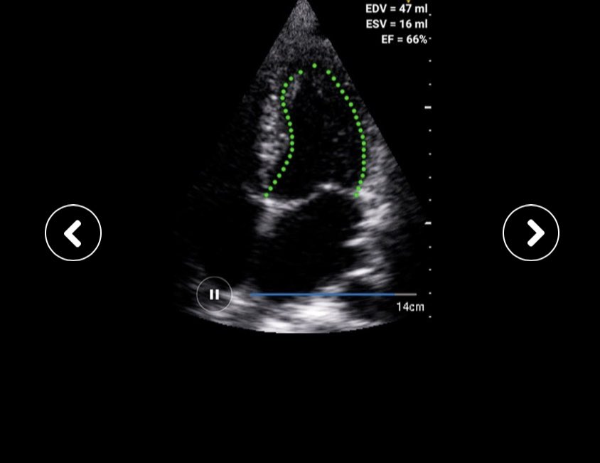 When you need accurate fast measurements check out the <a href="/vscan/">GE HealthCare Vscan Family</a> extend <a href="/DiA_Analysis/">DIA IMAGING ANALYSIS</a> #AI based solution #POCUS #Handheld #Vscan