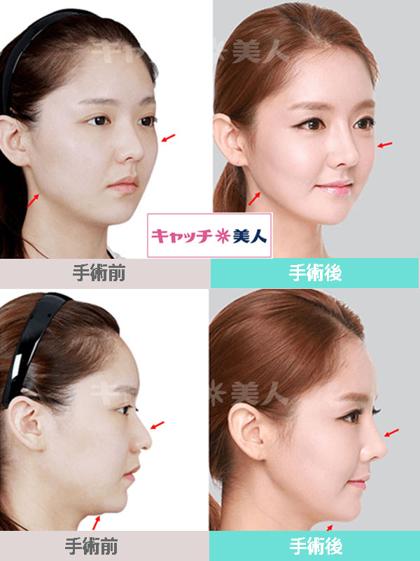 キャッチ美人 韓国整形美容サポート Catchmijp Twitter