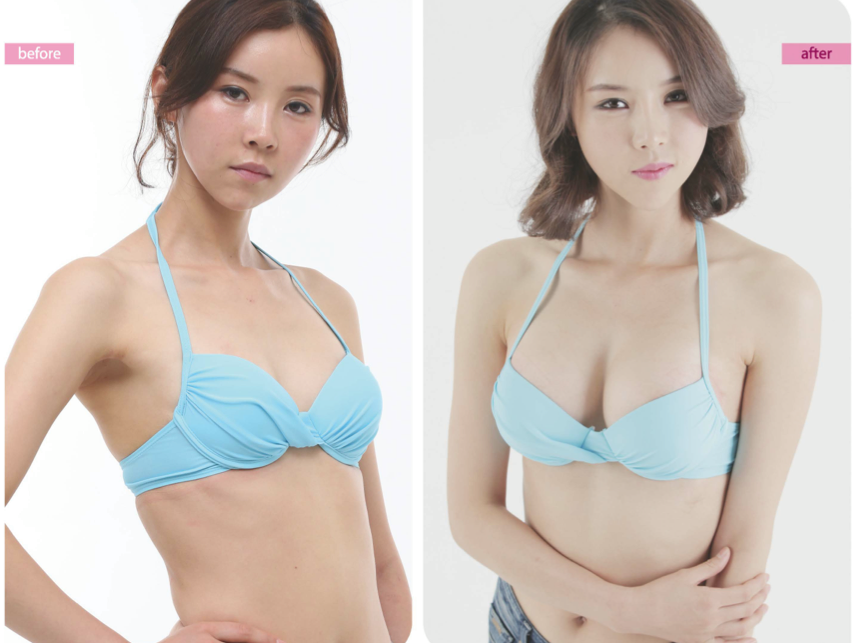 Easta Medical on X: Breast reduction surgery More