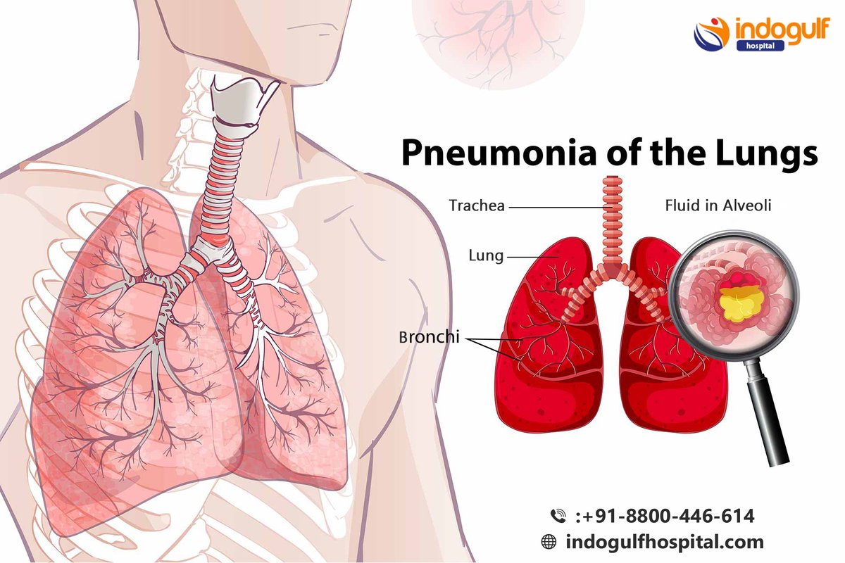 IndogulfHofc's tweet photo. #Trachea #Lung #Bronchi #FluidinAlveoli
1 Cough, which may produce greenish, 
3 Shortness of breath.
4 Rapid, shallow breathing.
5 Sharp or stabbing chest pain that gets worse when you breathe deeply or cough.
6 Loss of appetite, low energy, and fatigue
  https://t.co/eICYnyZfMx https://t.co/r2okAUjoQy