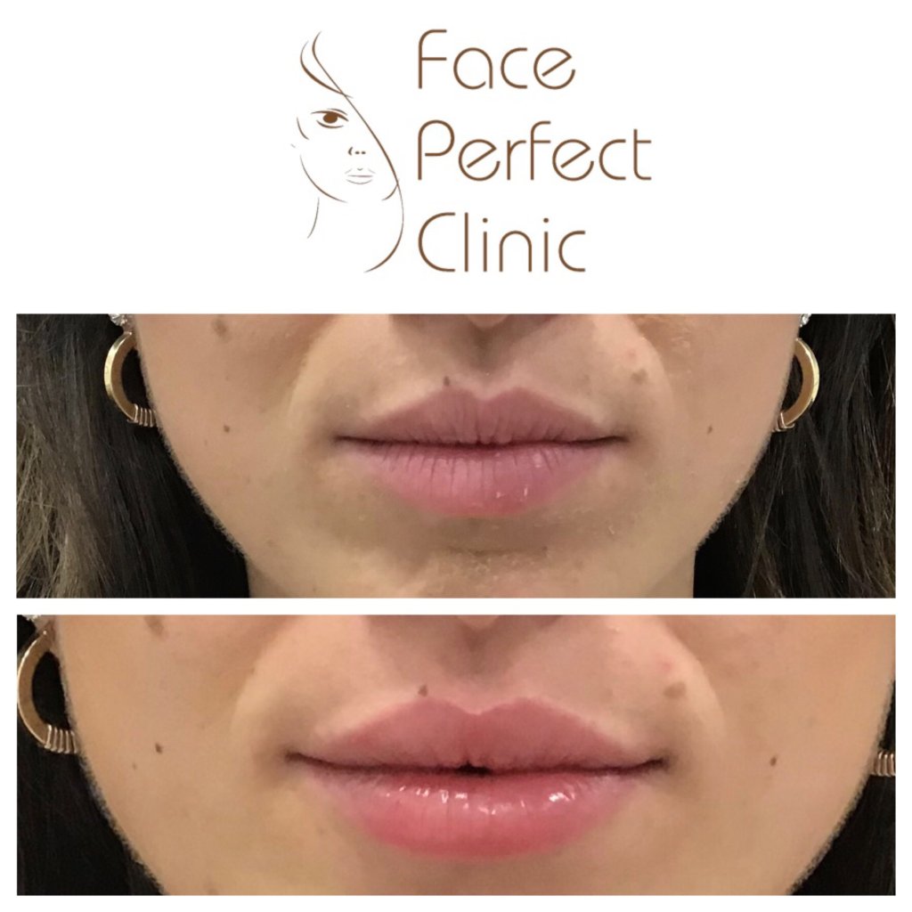 One of our most popular treatments at the Face Perfect Clinic is Lip Augmentation - aka Lip Fillers.

Our safe and effective treatment adds volume and balance to the lips, leaving a soft and natural look. 

For the best treatments in Leeds, get in touch 👄 bit.ly/2oAuEmv