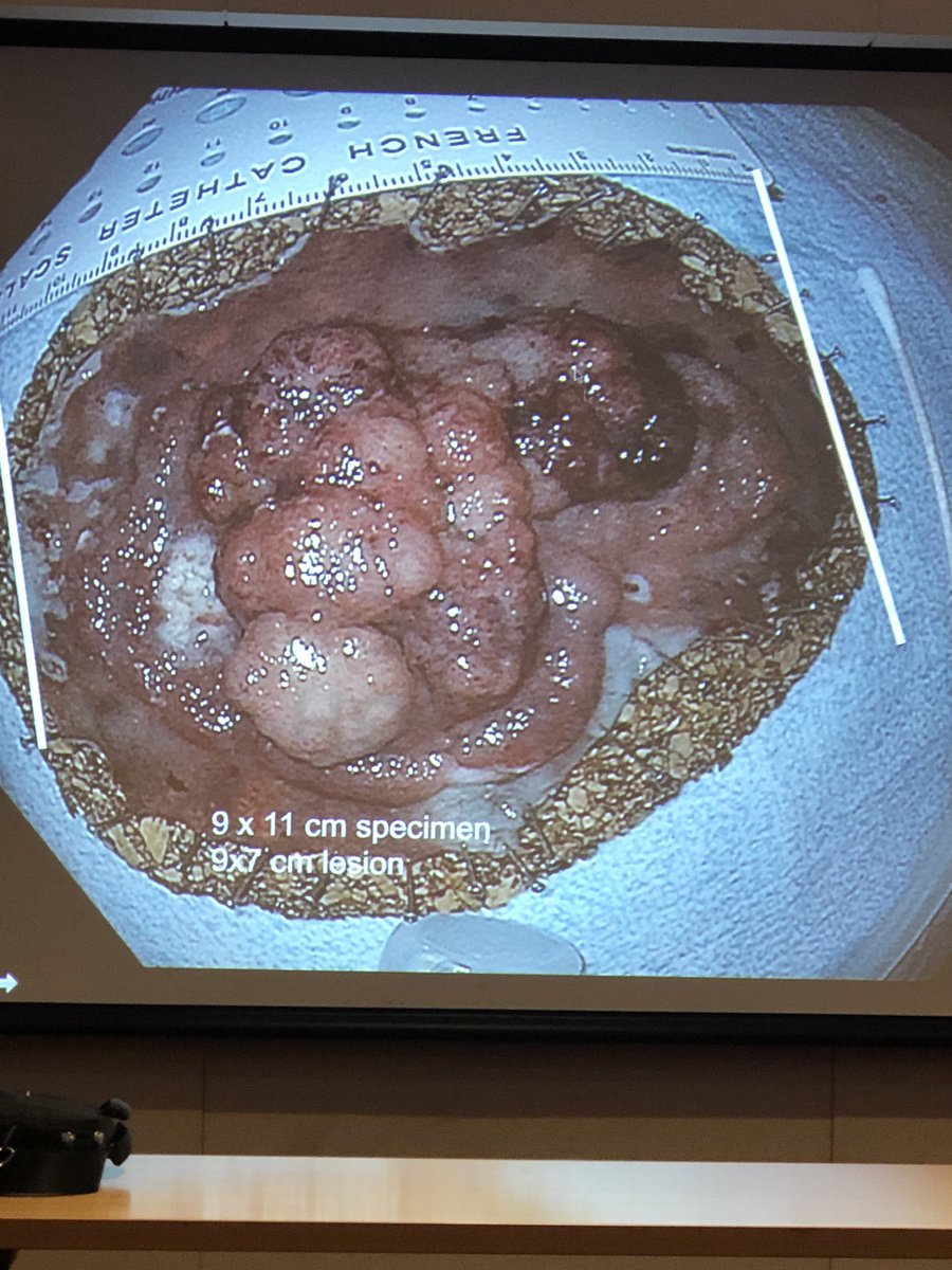 Dana_Lukin's tweet image. Timely lecture on #ESD and advanced #polypectomy during #ColonCancerAwarenessMonth by Stavros Stavropoulos at ⁦@WCM_GI⁩ GR this morning. #Polypalooza ⁦@AmCollegeGastro⁩