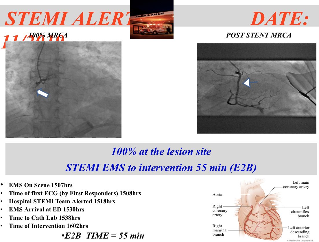 EMSOfficer's tweet photo. Great to see our EMS to Balloon times continue to improve. A BIG job well done to the crew & hospital staff. #EMS #Leadership #FLEMS #EMSOfficer #LeanSixSigma #Collaboration #ThankYou #ReleaseTheShips #People https://t.co/xX880E8UMX