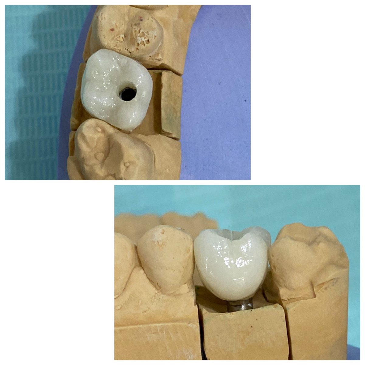 Dr_maherhajjaj's tweet photo. Monolithic screw-retained zirconia crowns for tooth #3 (#16), Shade BL3.
Strength, beauty and retrievability.
#طبيب_الأسنان #تركيبات_اسنان #تلبيسه #تبيض_الاسنان #تجميل #تجميل_الاسنان #زركون #زراعة_أسنان
#prosthodontist #crowns #zirconia ##screwretained https://t.co/2DTFVp1rqP