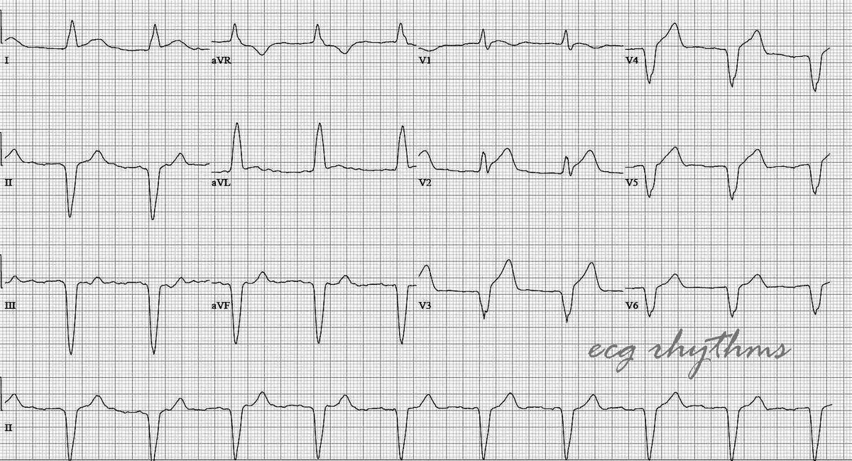 #ecgarchives 

Let's say you are an AI and shown this #ecgpattern. 
What will be (you) the AI's interpretation?

#FOAMed #meded #cardiology #cardiotweeter
#medstudenttwitter #NurseTwitter