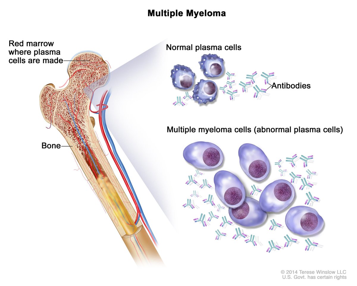power4patients's tweet photo. Multiple Myeloma is a #bloodcancer of the plasma cells. It is the second most common blood cancer with more than 30,000 new diagnoses last year. #MultipleMyelomaAwarenessMonth #MMAM #multiplemyloma #mmsm https://t.co/ZMVyxphldf