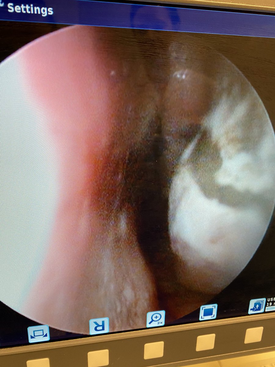stamfordENT's tweet photo. Pyogenic Granuloma in the nose. Not all #nasalcongestion is #allergies https://t.co/xPJB6pm1s8
