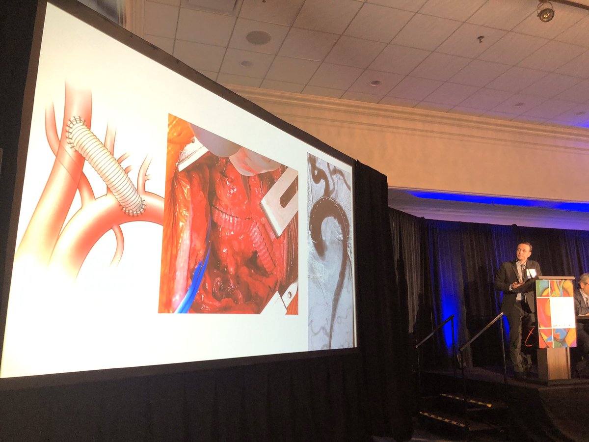 DrAliAzizzadeh's tweet photo. Great talk by @BruceTjadenMD on oropharyngeal complications after cervical debranching before TEVAR. Should retropharyngeal carotid carotid bypasses be approached with caution? #HAS2020 https://t.co/UqrPECFY6r