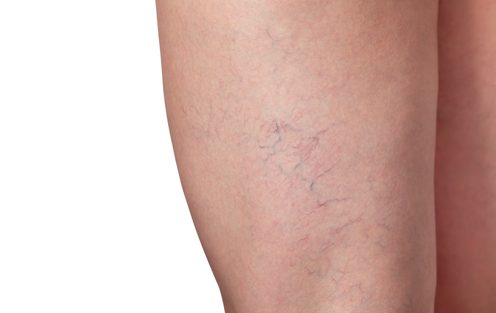 FDTysonsCorner's tweet photo. Hypertonic saline sclerotherapy is a proven treatment used to eliminate varicose veins and  spider veins. A non-chemical concentrated salt water solution effectively eliminates the vein by creating scar tissue that blocks the vein. Call (703) 544-7585 to schedule a consultation. https://t.co/Ype6JhJdgg