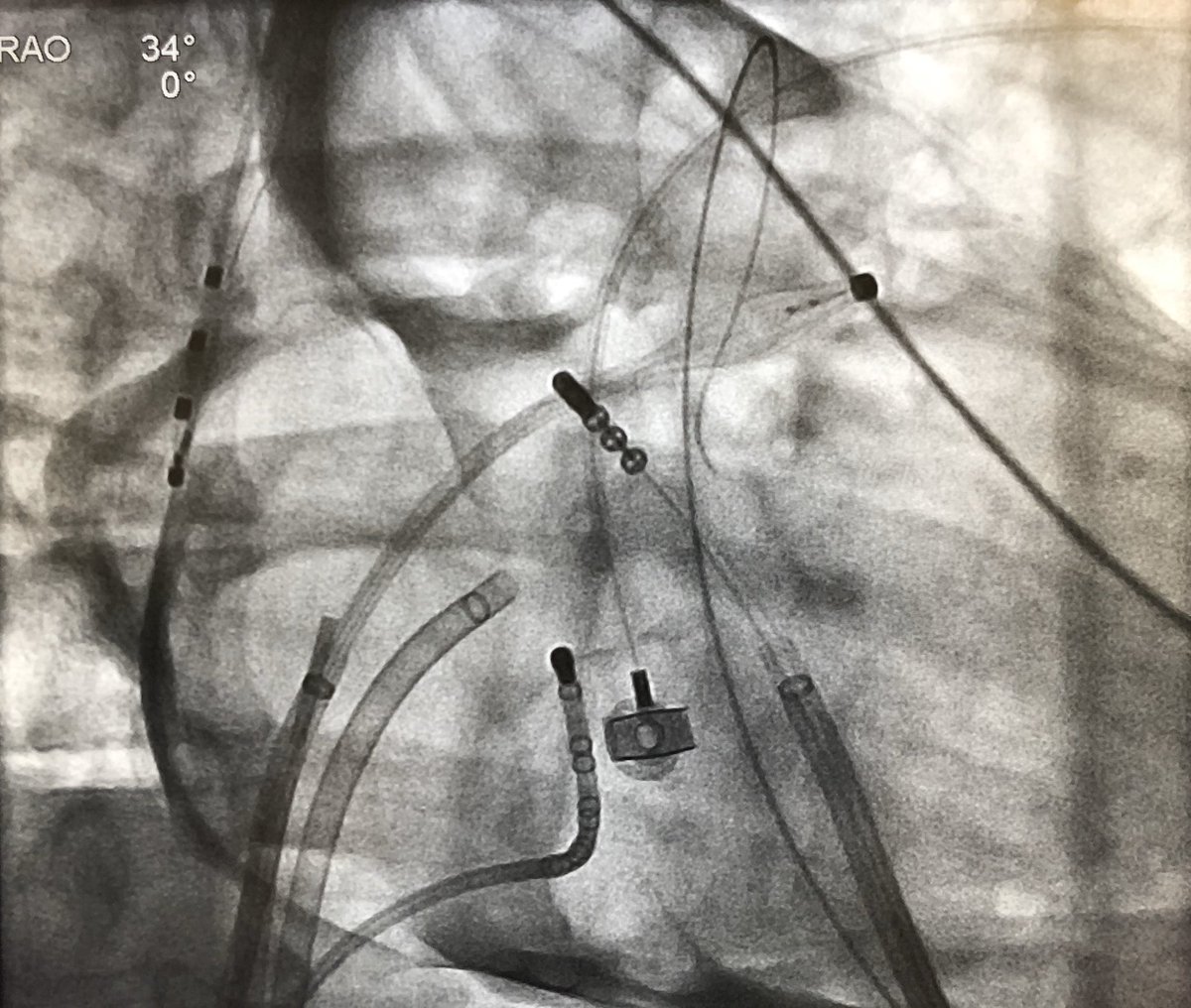 Excited to show this epicardial AF case at #EPLive ! - with @andreanatalemd @aalahmadmd #AFin3D