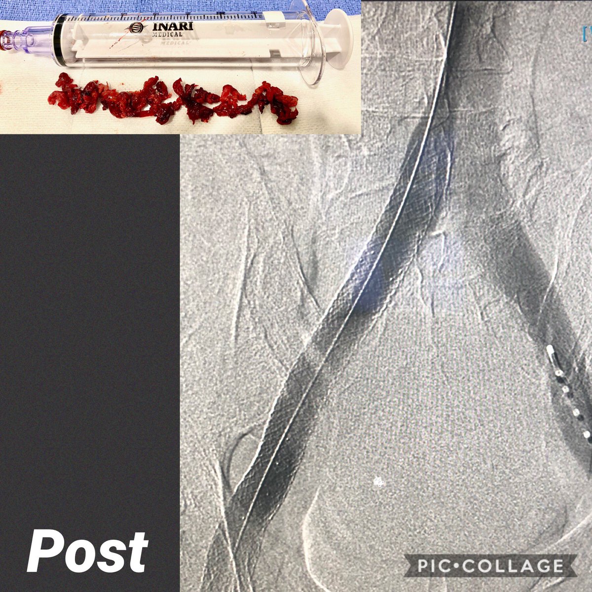 Back to back clot haul day. Case 1 acute, case 2 acute on chronic. @InariMedical Clottriever for the win. No ICU, no overnight lysis.