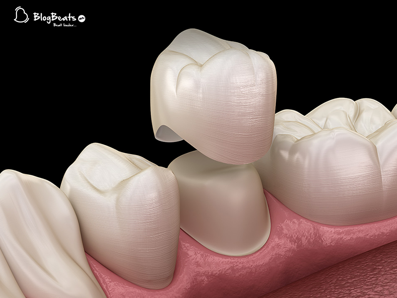 Why do you need dental crowns?
bit.ly/2wrmaVY
#Dental #crowns