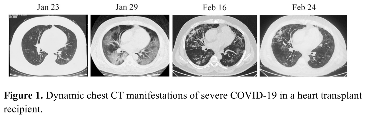 First cases of #COVID19 in #hearttransplantation from China. First case mild and required supportive care. Second case was severe, immunosuppression was temporarily stopped, treated with steroids and IV human gamma globulin, and eventually recovered. jhltonline.org/pb/assets/raw/…