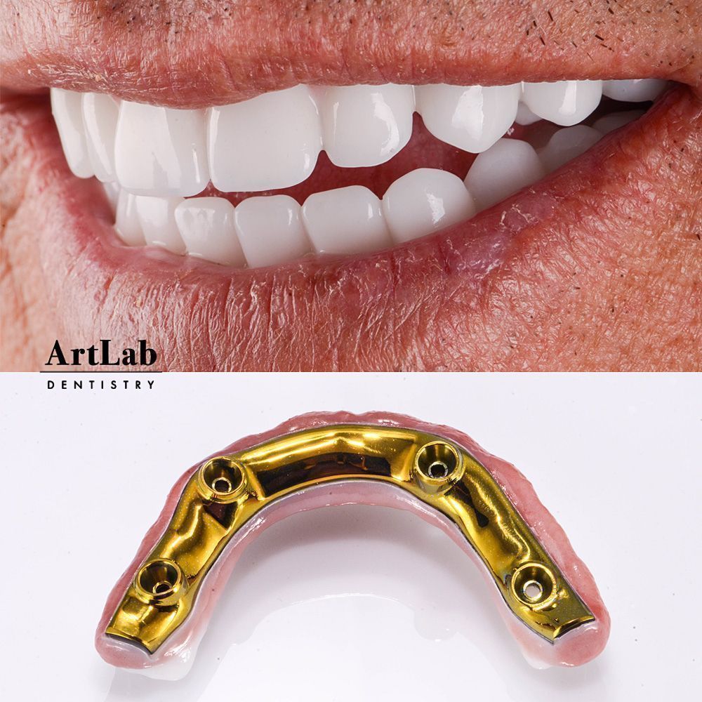ArtLabDentistry's tweet photo. Another beautiful smile restored at ArtLab Dentistry - this is a gold-plated titanium bar on this full mouth reconstruction. https://t.co/Z49sSQesT0 #dentalimplants #newsmile #innovation https://t.co/drvesRjxAh