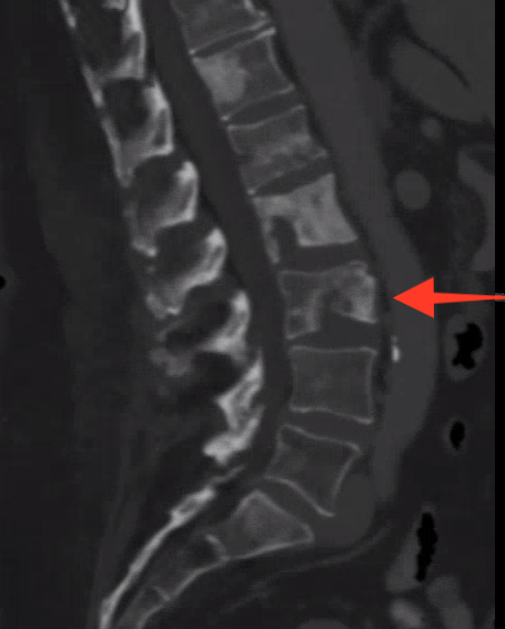 urmed_ir's tweet photo. #IRad can provide comfort to patients with back pain from metastatic disease, allowing them to enjoy everyday a little more. Case of an uncomplicated kyphoplasty – pt with 9/10 -> 4/10 pain on the 1 week follow up.

#BasicIR #interventional #Radiology #TwittIR #InnovationToHeal https://t.co/mCXvVfAwXF