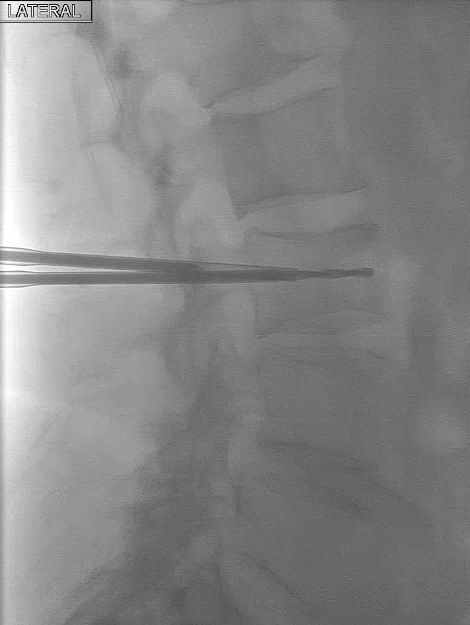 urmed_ir's tweet photo. #IRad can provide comfort to patients with back pain from metastatic disease, allowing them to enjoy everyday a little more. Case of an uncomplicated kyphoplasty – pt with 9/10 -> 4/10 pain on the 1 week follow up.

#BasicIR #interventional #Radiology #TwittIR #InnovationToHeal https://t.co/mCXvVfAwXF
