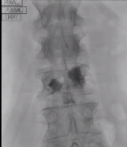urmed_ir's tweet photo. #IRad can provide comfort to patients with back pain from metastatic disease, allowing them to enjoy everyday a little more. Case of an uncomplicated kyphoplasty – pt with 9/10 -> 4/10 pain on the 1 week follow up.

#BasicIR #interventional #Radiology #TwittIR #InnovationToHeal https://t.co/mCXvVfAwXF