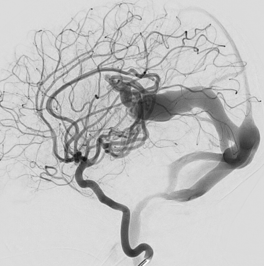 kanachan2020's tweet photo. #VGAM #identical #twin They had no endoglin, RASA1 or EPHB4 mutations. World Neurosurg 91:672.e11-672.e15, 2016 pre-DSA and post-2 x embo day 4 MRA https://t.co/jRQAnX4K0p