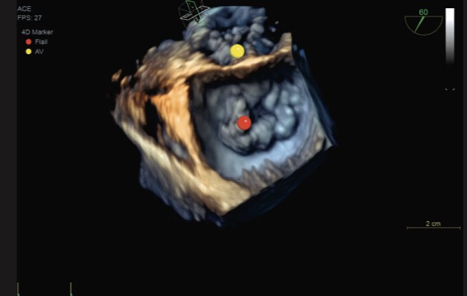Intra-operative 4D TOE this week. 4D markers makes life so much easier when describing pathology! #echofirst #VIVID #4D