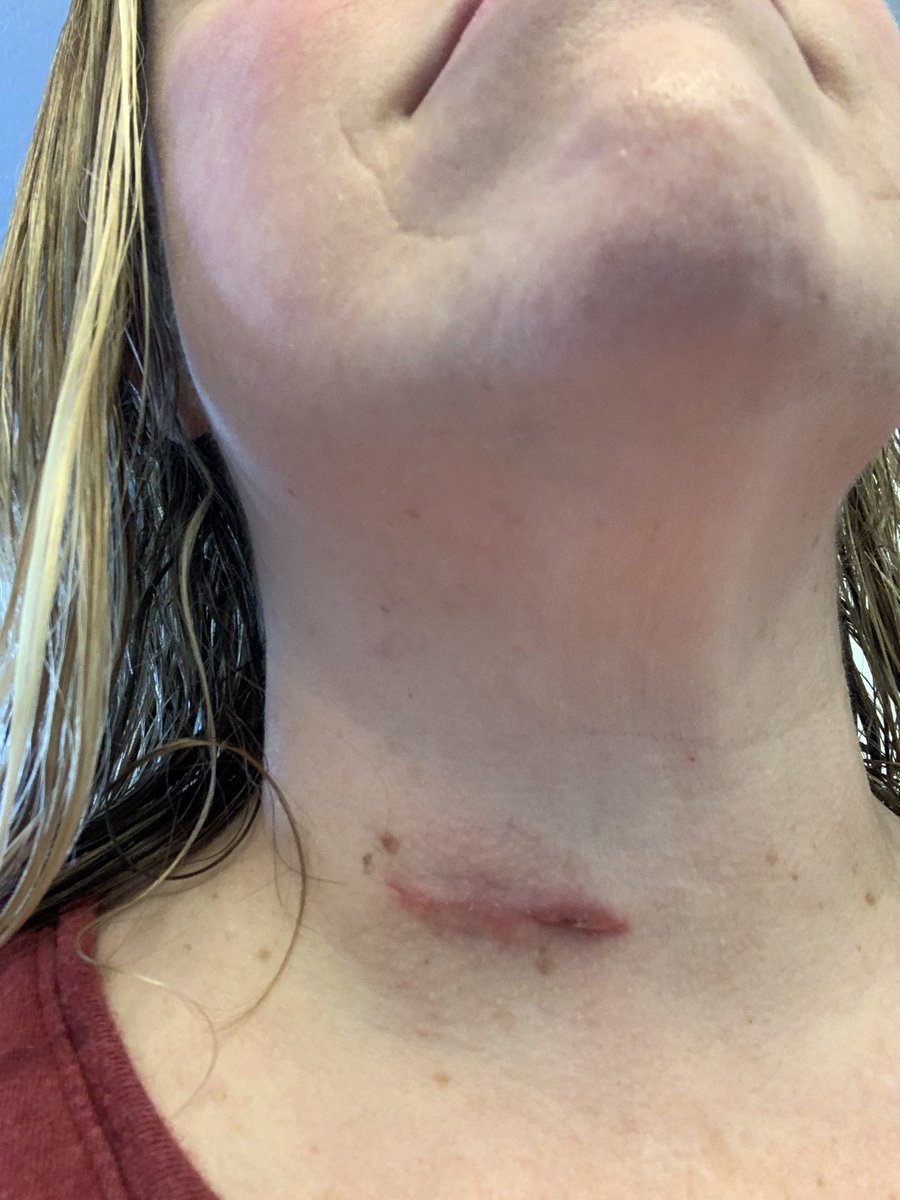 meri_munn's tweet photo. Add one more scar to my collection! Itโs a doozy!! But check out those laugh lines! Iโm most proud of those! #Hitbyabus #ChronicPainLady https://t.co/RqUqZTAHuB