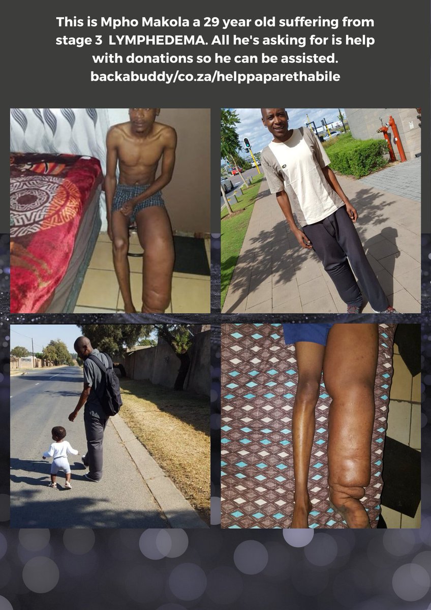 Gemini_Papi_'s tweet photo. Hey y'all,
Kindly join me and many others around the world in creating awareness about Lymphedema today. Also please use the link below to donate towards @mphomokola 's treatment. Thank you.
https://t.co/Nt1Ae5SkeE
#HelpPapaRethabile
#WorldLymphedemaDay https://t.co/9oj5WDAlNL