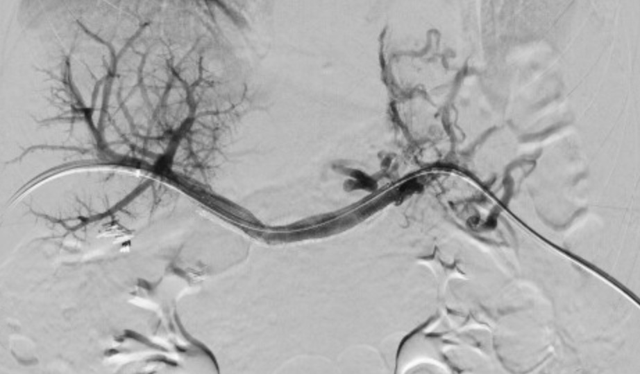 Zagum Bhatti MD (@zagumbhatti) on Twitter photo Revasc of chronic splenic and MPV occl for bleeding #varices refractory to banding and medical therapy using #Vici stent. #IRad <a href="/CarlosGuevaraIR/">Carlos Guevara MD, FSIR</a> <a href="/TheRealDoctorOs/">Osman Ahmed</a> <a href="/ahmed_kamel_ir/">Ahmed Kamel MD, PhD, FSIR</a> <a href="/bsc_pi/">Jeff Mirviss</a> <a href="/UTHouston_IR/">UT Houston_IR</a> <a href="/UTHealth/">UTHealth</a> <a href="/SIRspecialists/">Society of Interventional Radiology</a> Revasc of chronic splenic and MPV occl for bleeding #varices refractory to banding and medical therapy using #Vici stent. #IRad <a href="/CarlosGuevaraIR/">Carlos Guevara MD, FSIR</a> <a href="/TheRealDoctorOs/">Osman Ahmed</a> <a href="/ahmed_kamel_ir/">Ahmed Kamel MD, PhD, FSIR</a> <a href="/bsc_pi/">Jeff Mirviss</a> <a href="/UTHouston_IR/">UT Houston_IR</a> <a href="/UTHealth/">UTHealth</a> <a href="/SIRspecialists/">Society of Interventional Radiology</a>