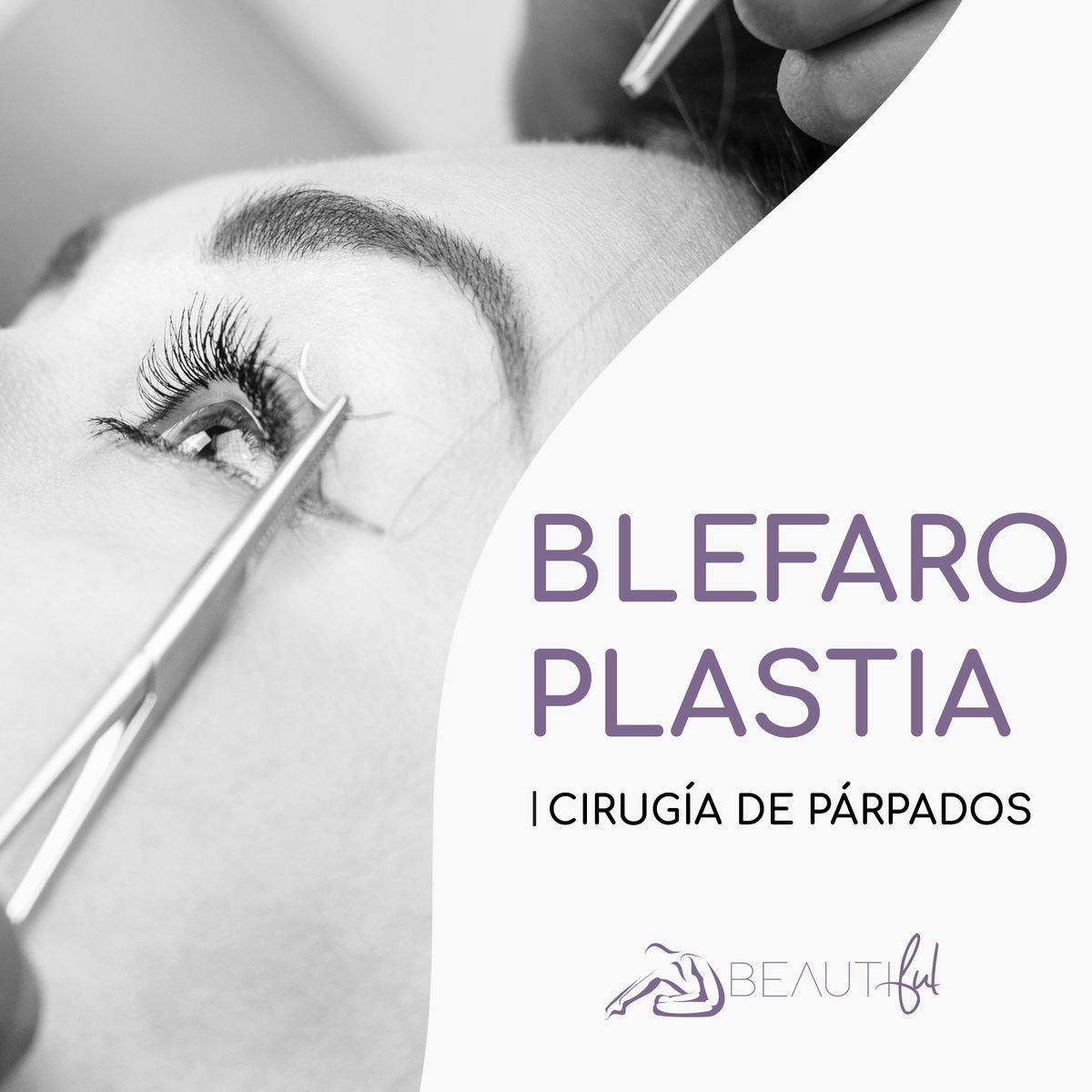 #CIRUGÍA
👩‍🦳La piel que rodea los ojos se vuelve flácida y los músculos van perdiendo fuerza.
👁 La blefaroplastia es un procedimiento para corregir la caída de los párpados superiores, y las bolsas de los inferiores.

#ClinicaBeautifulTarragona #cirugiatarragona #tarragona #tgn
