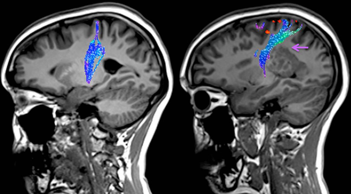 EpilepsiaRuber's tweet photo. Las malformaciones del neurodesarrollo pueden desplazar los tractos y funciones corticales. Esto es importante en la evaluación prequirúrgica en epilepsia. A la izq, la vía motora es normal. A la derecha, está desplazada como consecuencia de una malformación extensa.
#Epiteca https://t.co/F9gXtmGJvq