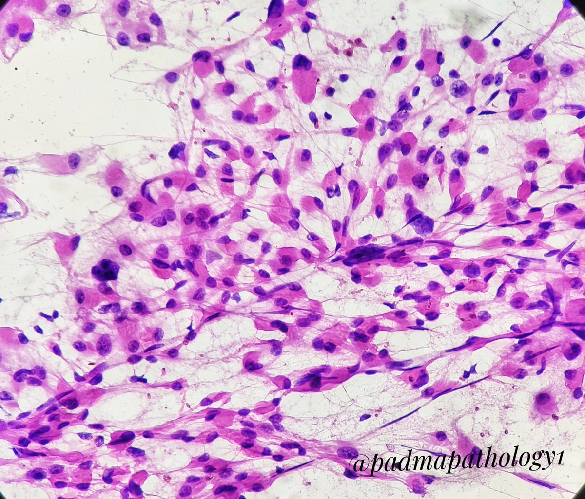 padmapathology1's tweet photo. These cells reminded me of @tralimiguel's recent #cytopath case. Large cells, abundant cytoplasm, eccentric nucleus. #GuessTheDiagnosis. Only clue: middle aged male (not actually a clue π) #pathology #pathquiz #pathpuzzler
https://t.co/QIIvAAzGva https://t.co/idNkGkIUfQ