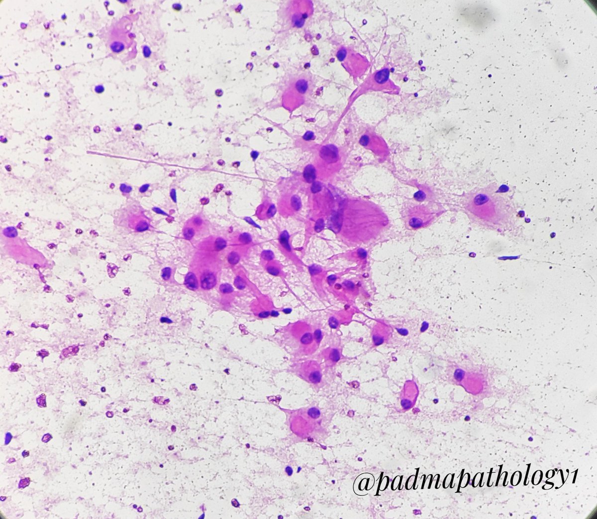 padmapathology1's tweet photo. These cells reminded me of @tralimiguel's recent #cytopath case. Large cells, abundant cytoplasm, eccentric nucleus. #GuessTheDiagnosis. Only clue: middle aged male (not actually a clue π) #pathology #pathquiz #pathpuzzler
https://t.co/QIIvAAzGva https://t.co/idNkGkIUfQ