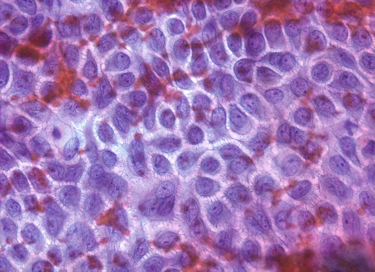 sza_jhcyto's tweet photo. "Spiders and more spiders" -  Spectacular appearance of an intact mesothelial cell sheet in a serous effusion specimen. Cells are anchored to each other like good neighbors with well-formed junctions and bridges. And yes, mesothelial cell nuclei very often have beautiful grooves. https://t.co/0g6bNjgqTU